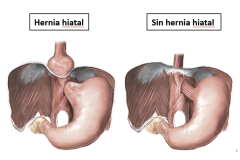 hi - hernia-hiatal-4